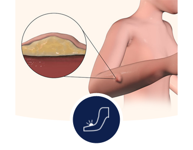 Lipoma