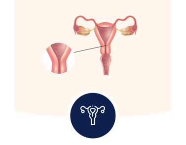 Uterus Removal